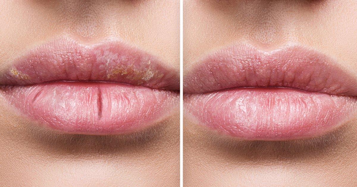 Cómo cuidar los labios y evitar que se agrieten