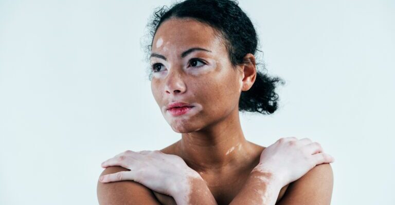 Vitiligo 1