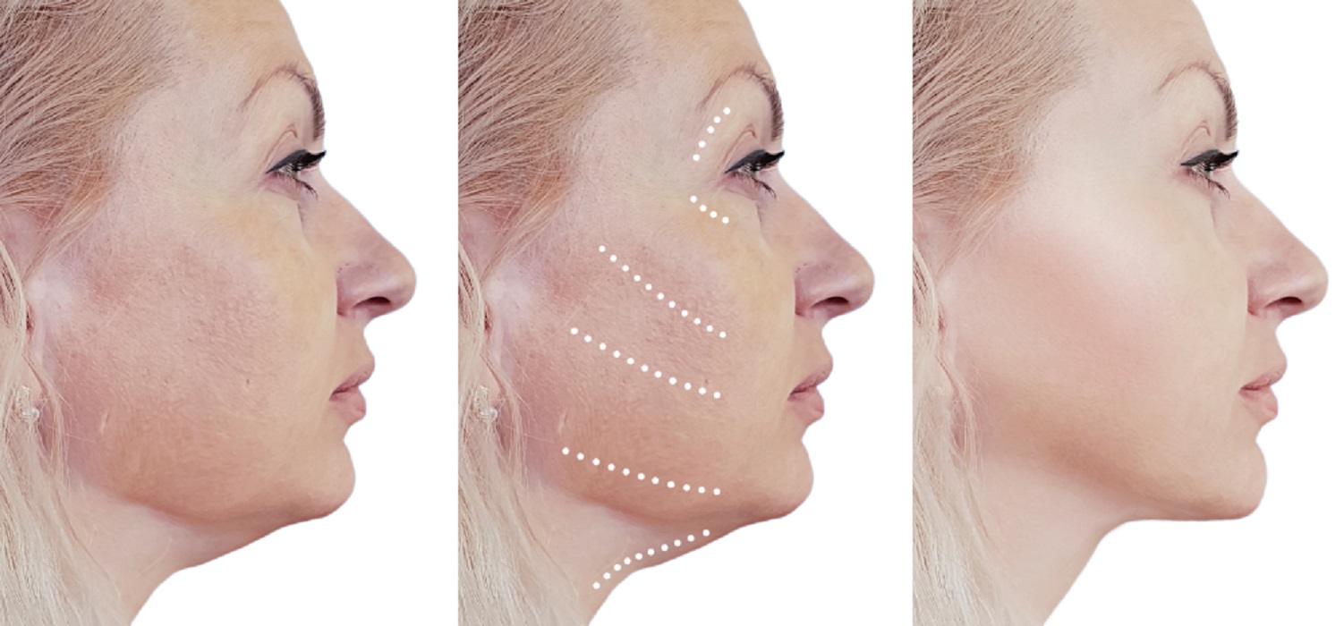 Mini Lifting Facial: rejuvenece 10 años en 2 horas